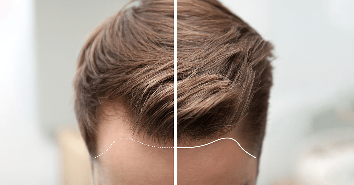 how-to-stop-receding-hairline-in-men