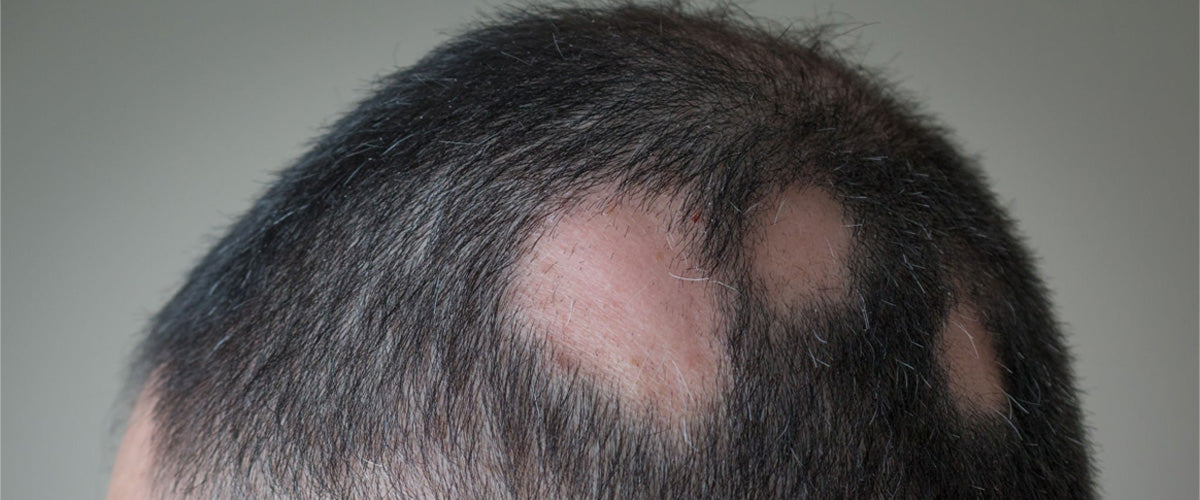 Alopecia Areata