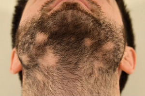 What is Alopecia Barbae: Causes, Signs, Symptoms and Treatment
