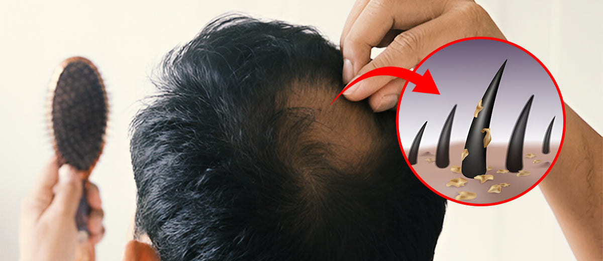 Balding: Early Signs, Causes and Treatments