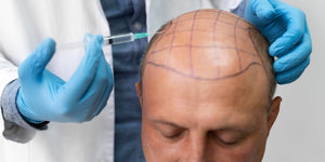 Hair Transplantation: Process, Complications and Side Effects