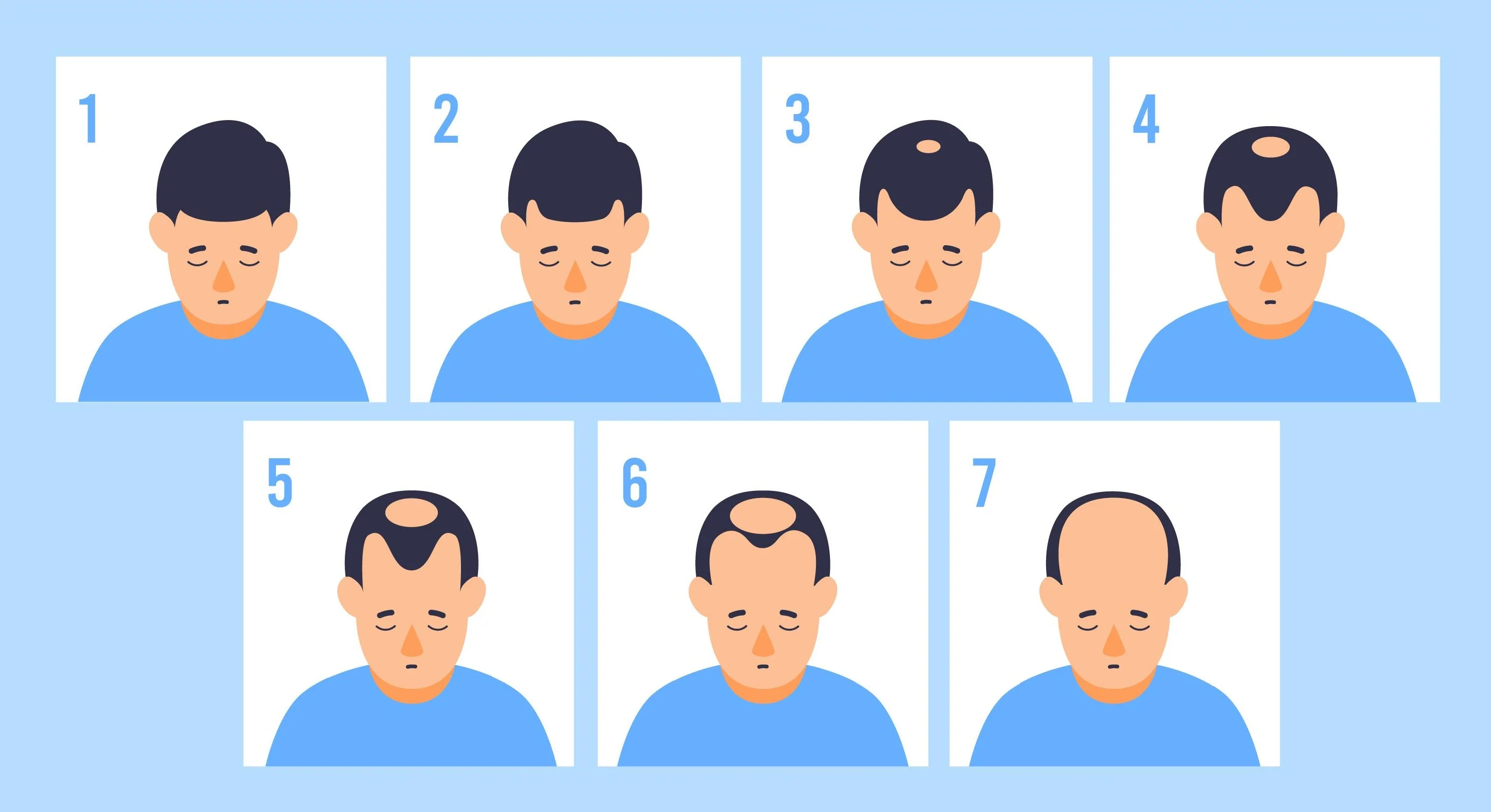 Male Pattern Baldness: What are the Different Stages of Hair Loss in Men?