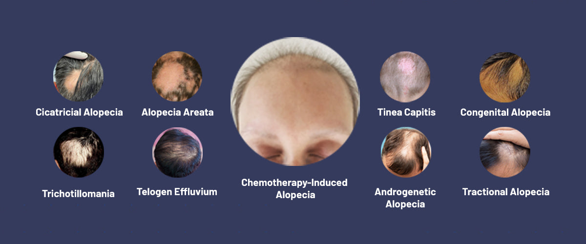 Types of Alopecia: Different Types of Male Pattern Baldness