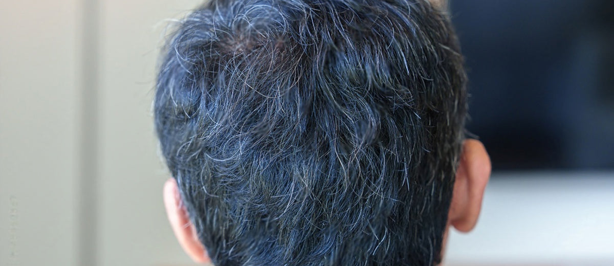 What Causes White / Grey Hair?