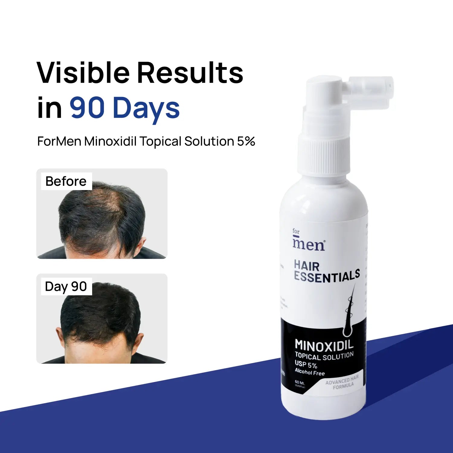Minoxidil Topical Solution 5% – Clinically Proven Formula for Hair Regrowth (60ml)